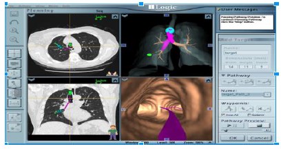 Automatically registering CT scan data in the Bronchoscopy system